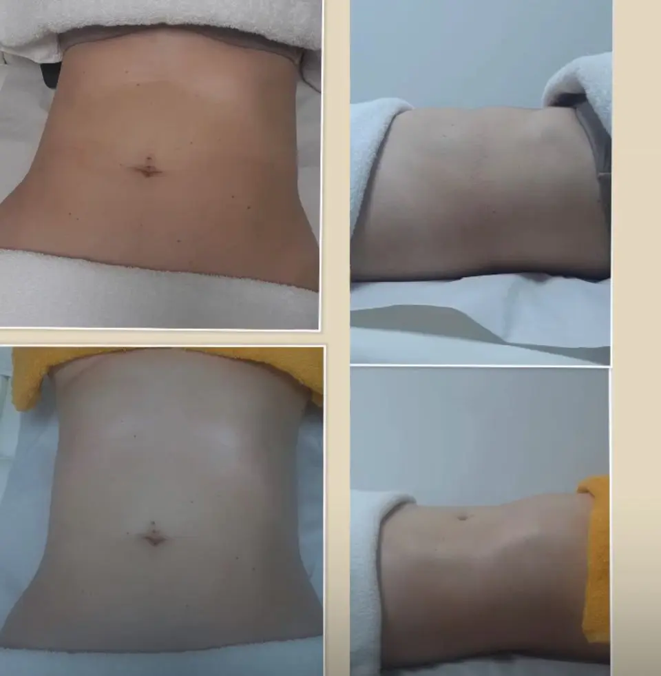 tratamiento corporal 1